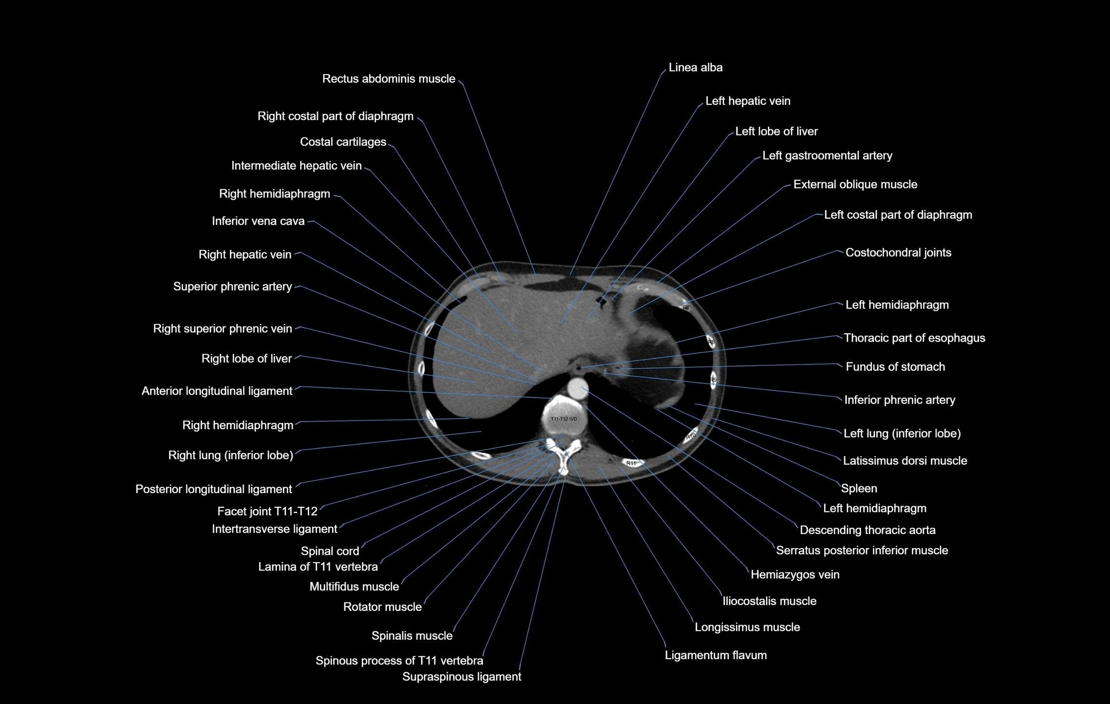 CT chest (thorax) labelled axial cross sectional anatomy radiology image-00106.webp